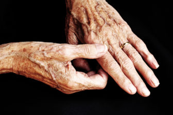Rheumatoid arthritis often affects smaller joints, like those in the hands. 